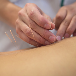 L acupuncture